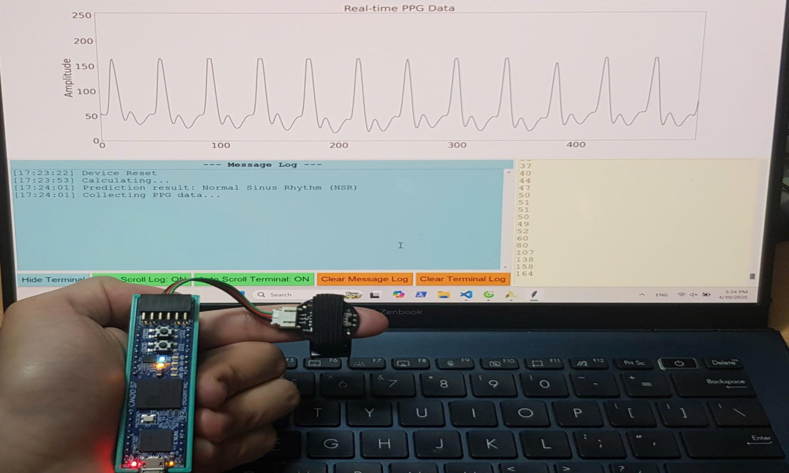 Chip SNN phát hiện rung nhĩ (EDABK AF Detector)